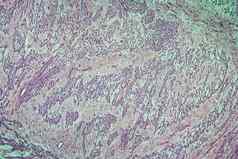 纤维肌瘤子宫病组织