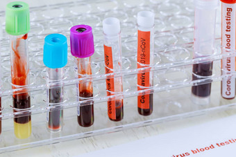 冠状<strong>病毒</strong>血测试法律顾问萨尔斯科夫梅尔斯科夫血测试实验室