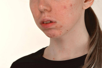 post-acne伤疤红色的不断恶化的青春痘脸年轻的女人概念皮肤问题谐波失败