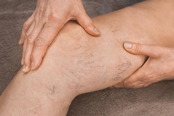 手上了年纪的女人显示静脉曲张的静脉生病的女腿