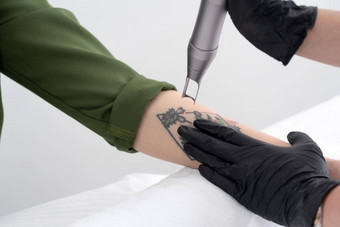 美容师激光设备删除不需要的纹身女手臂概念擦除纹身昂贵的过程美容诊所