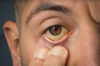 生病的男人。检查黄色的眼睛高胆红素水平肝硬化肝炎肝疾病肝问题黄疸