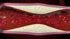 动脉粥样硬化胆固醇血斑块船冠状动脉动脉疾病