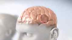大脑肿瘤集合质量不正常的细胞大脑