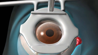 白内障手术应用程序视图外科手术操作人类眼睛
