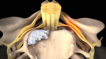 脊髓阀瓣<strong>椎间盘</strong>突出受伤缓冲连接组织椎骨