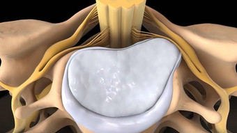 脊髓阀瓣<strong>椎间盘</strong>突出受伤缓冲连接组织椎骨