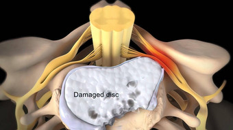 脊髓阀瓣<strong>椎间盘</strong>突出受伤缓冲连接组织椎骨