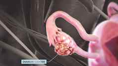 卵巢癌症疾病细胞卵巢乘成长异常