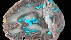 医疗插图人类大脑神经元活动