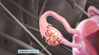 卵巢癌症疾病细胞卵巢乘<strong>成长</strong>异常