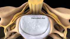 脊髓阀瓣椎间盘突出受伤缓冲连接组织椎骨