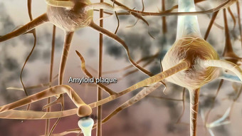 淀粉样蛋白板βd插图蛋白质涉及到老年痴呆症疾病