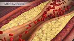 堵塞动脉血小板胆固醇斑块概念健康风险肥胖