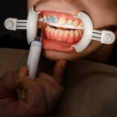 塑料牵开器唇增加口牙科过程牵开器辅助元素