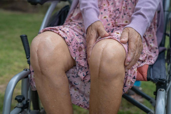 亚洲高级上了年纪的夫人女人病人显示伤疤外科手术总计膝盖联合更换缝合伤口手术关节成形术床上护理<strong>医</strong>院病房健康的强<strong>大</strong>的<strong>医</strong>疗概念
