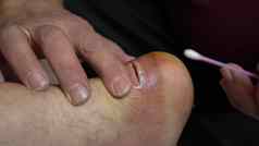 伤口治疗脓棉花拭子外科手术切口脚踝联合炎症