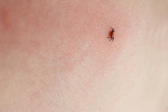 危险的昆虫蜱虫Ixodes蓖麻蜱虫吸人类皮肤臃肿的寄生虫咬男人。粉红色的恼怒的表皮脑炎感染莱姆疾病