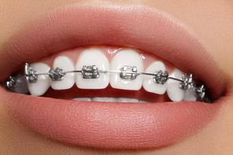 美丽的白色牙齿牙套牙科护理照片女人微笑牙医配件口腔正畸学治疗