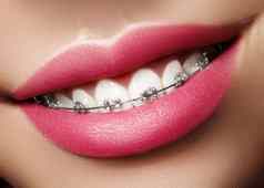 美丽的白色牙齿牙套牙科护理照片女人微笑牙医配件口腔正畸学治疗