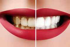 特写镜头宏女牙齿美白牙科健康口服护理概念快乐微笑红色的嘴唇