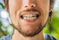 男人。放置咬板口保护牙齿晚上磨引起的夜间磨牙症