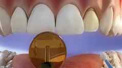 牙涂层过程干燥胶粘剂梁
