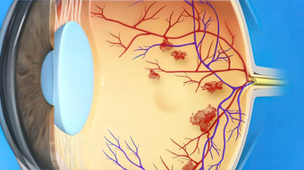 糖尿病黄斑水肿疾病眼睛解剖学
