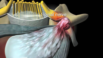 脊髓狭窄缩小骨运河神经脊髓绳通过
