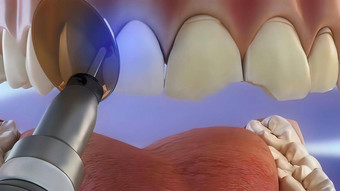 牙涂层过程干燥胶粘剂梁