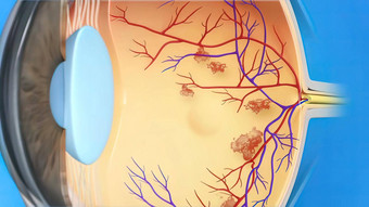 糖尿病黄斑水肿疾病眼睛解剖学