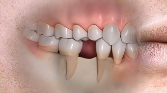 中断牙齿结构现实的医疗动画