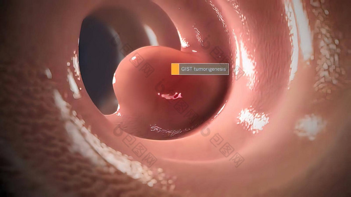 胃肠基质肿瘤罕见的类型癌症胃肠束