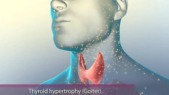 <strong>甲状腺</strong>机能亢进<strong>甲状腺</strong>腺生产<strong>甲状腺</strong>激素身体