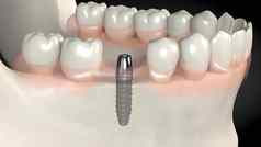 牙科植入物手术