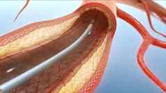 血管成形术血管支架
