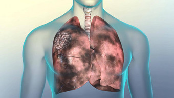 人类<strong>呼吸系统</strong>肺损坏的吸烟
