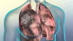 人类呼吸系统肺损坏的吸烟