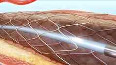 血管成形术血管支架