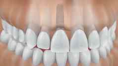 牙科植入物手术