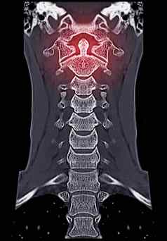 比较c-spine颈脊柱呈现图像矢状面