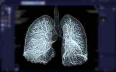 胸部肺呈现图像诊断肺结核科维德