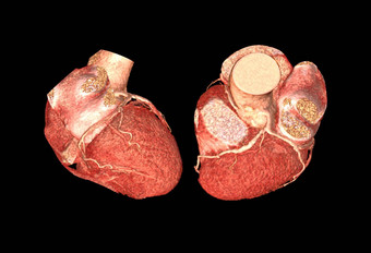 横向前视图进行合作。冠状<strong>动脉动脉</strong>呈现图像孤立的黑色的背景发现冠状<strong>动脉动脉</strong>疾病