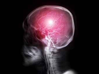 头骨x射线图像人类头骨<strong>横向</strong>视图融合mra大脑图像
