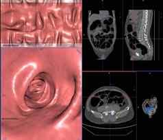 结肠镜扫描结肠轴向视图冠状视图呈现图像