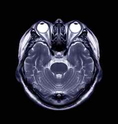 核磁共振大脑轴向