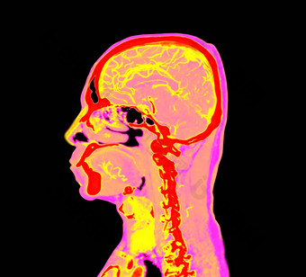 色彩斑斓的血管<strong>造影</strong>术大脑进行合作。大脑矢状面视图剪裁路径