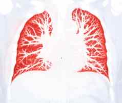 胸部肺预设检测到肺结核