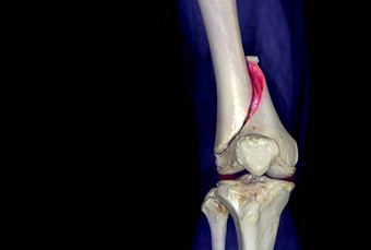 膝盖呈现图像视图孤立的黑色的背景显示骨折股骨骨