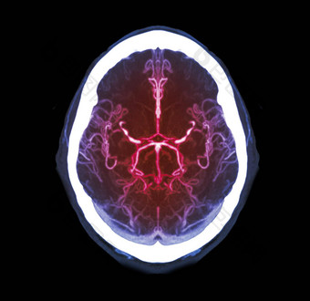 集合进行合作。大脑血管造影术大脑比较米兰理工大学管理学院技术轴向视图检测大脑阿努尤里姆